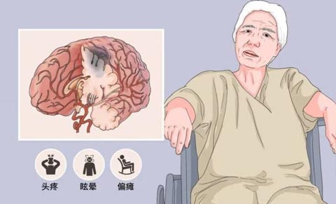 國內已有5款新藥IND獲批,干細胞治療腦卒中的臨床研究進展